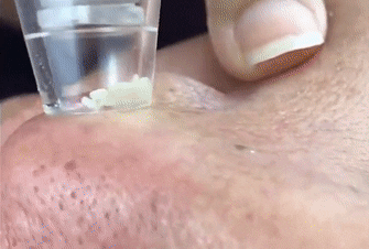 Extractor de impurezas | Belleza Perfecta 22